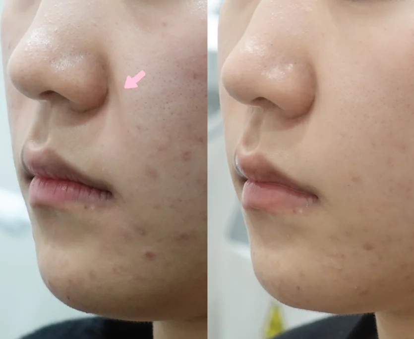 팔자 꺼짐 레디어스 시술 전후