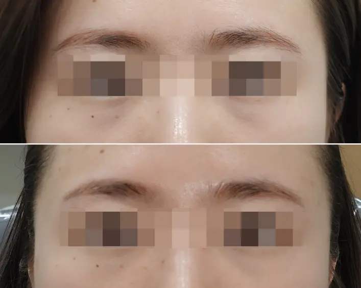 Before and After UltraColl Treatment