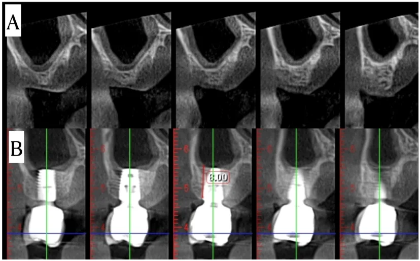 치조정 상악동 거상 증례 연구에 실린 위턱 어금니 부위 CBCT 세로 단면 A·B 패널 (논문 도판)
