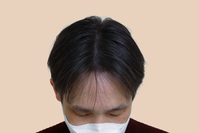 헤어라인 두피문신 결과 — 주변 모발에 자연스럽게 녹아든 쉐도우도팅 (도트락 강남 본점)