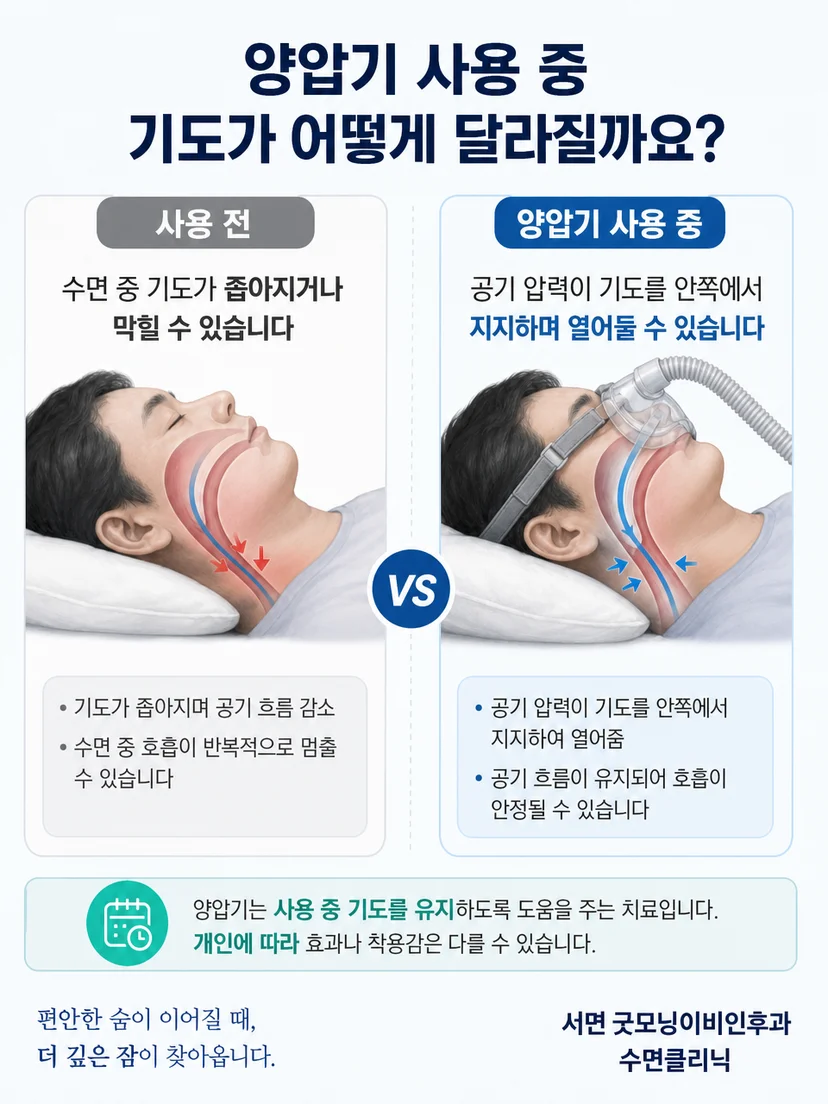 양압기가 완치가 아니라 사용 중 기도를 유지하는 치료임을 설명하는 그림