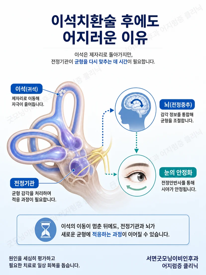 이석치환술 후 균형 감각이 다시 적응하는 원리를 보여주는 교육 이미지