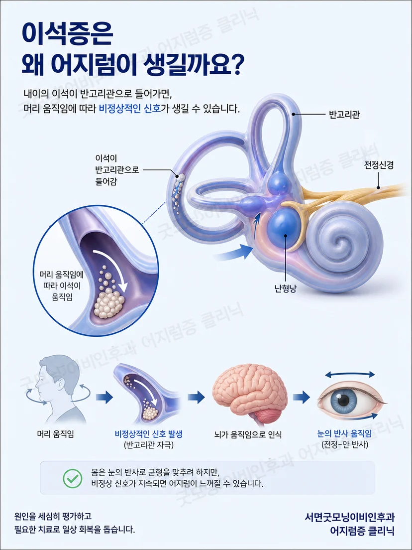 이석이 반고리관으로 이동해 자세성 어지럼을 만드는 원리