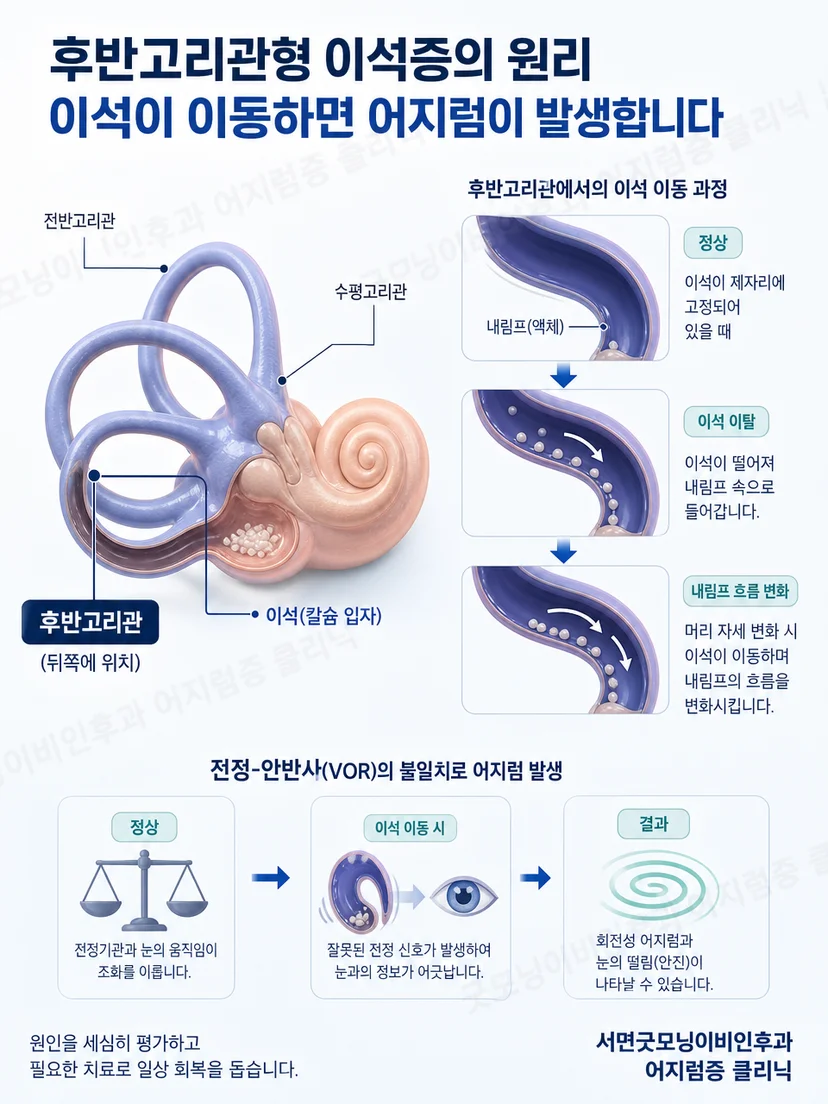 후반고리관 위치와 이석이 이동하는 기본 원리 도식