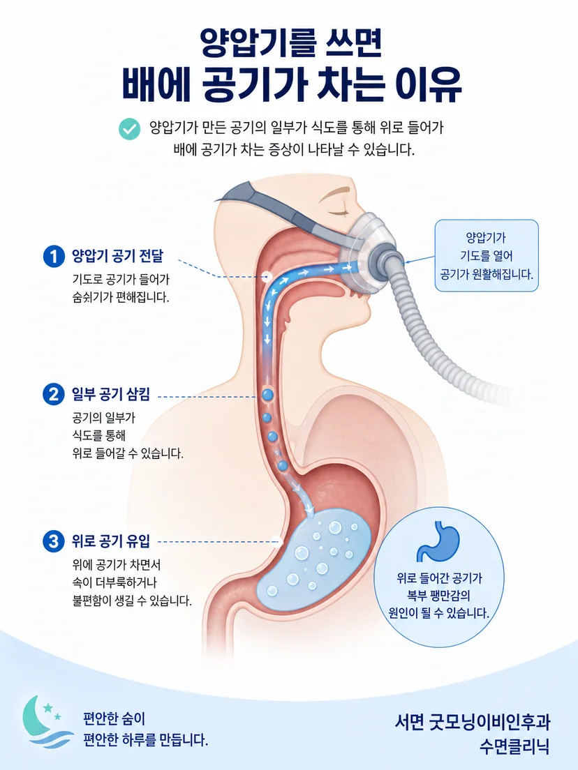 양압기 공기 일부가 식도와 위장으로 넘어가는 원리를 설명하는 이미지