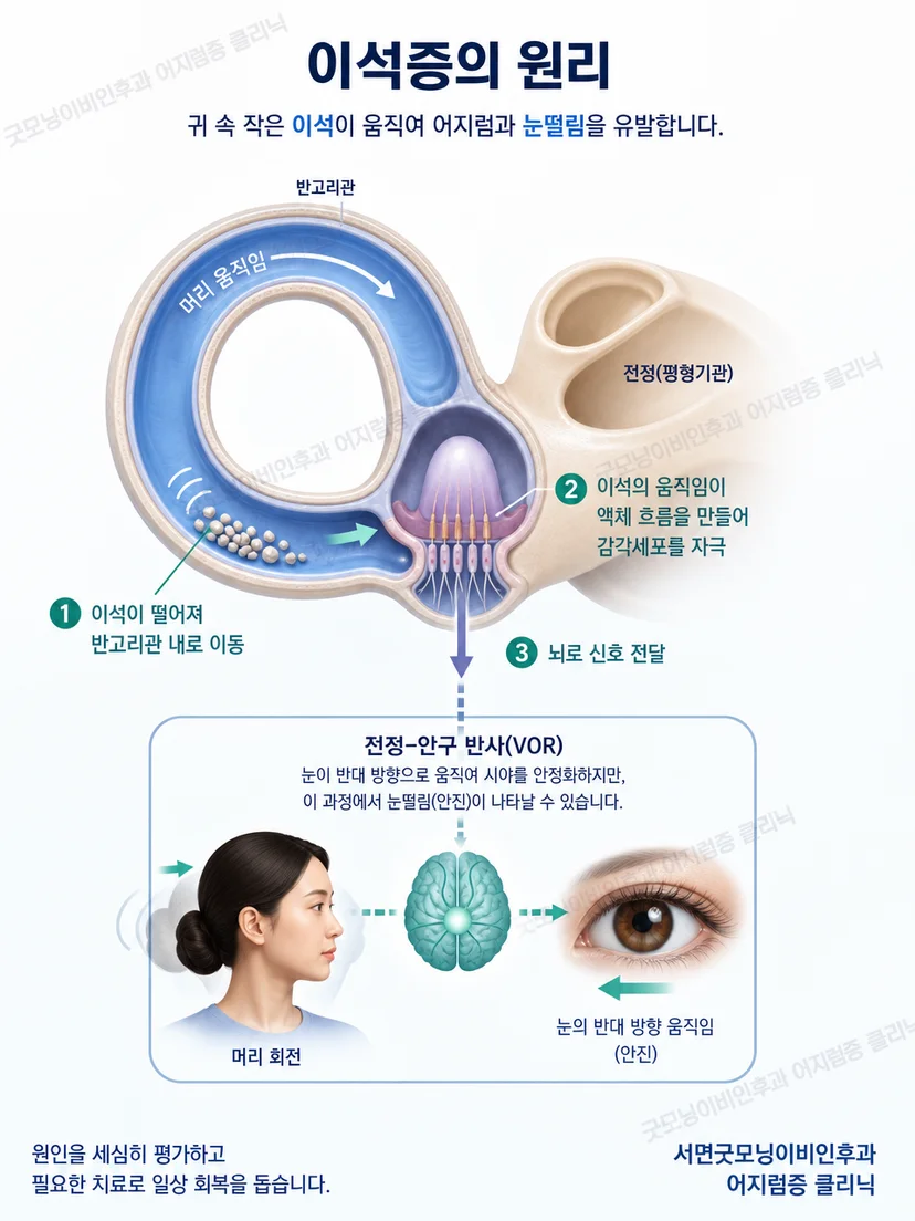 반고리관과 머리 방향 변화에 따른 이석 이동 원리 도식