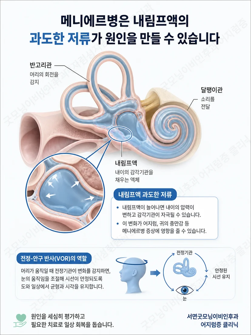 메니에르병 증상 변동과 생활 관리 원리를 설명하는 이미지