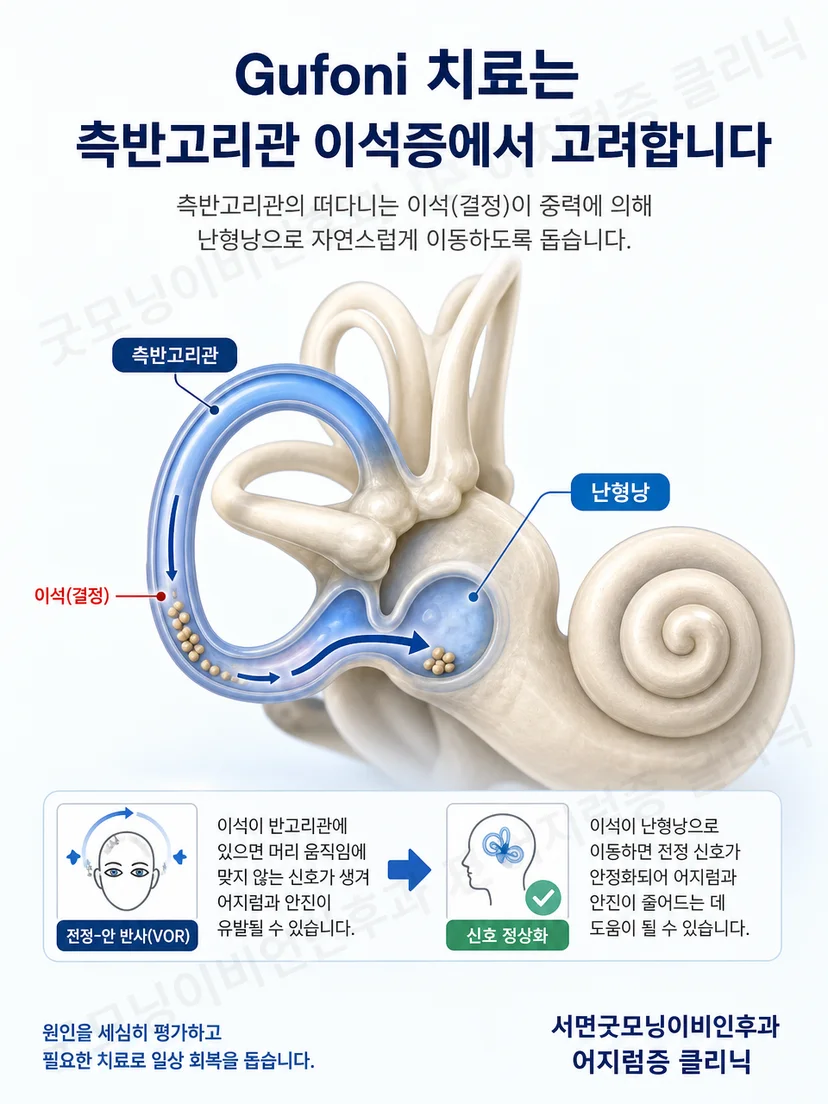 수평반고리관 안에서 이석과 머리 움직임이 어지럼을 유발하는 원리