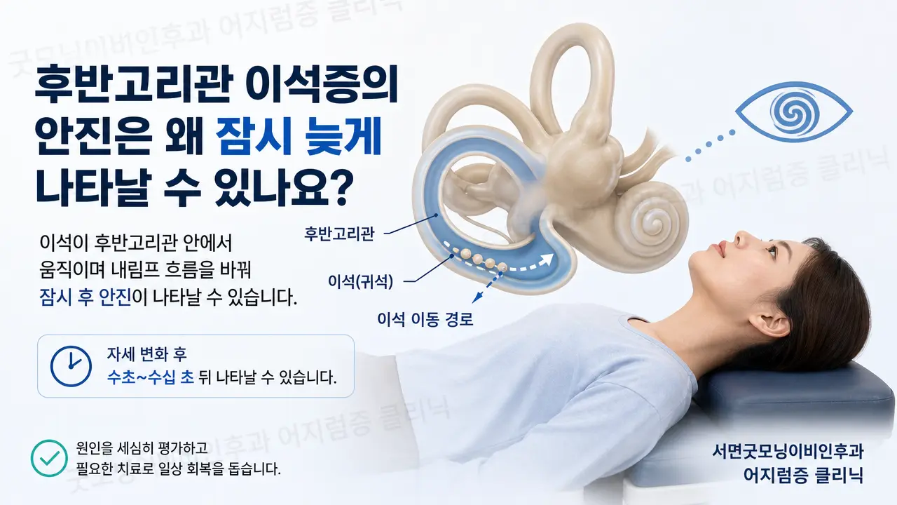 부산 이석증 | 후반고리관 이석증의 안진은 왜 잠시 늦게 나타날 수 있나요?