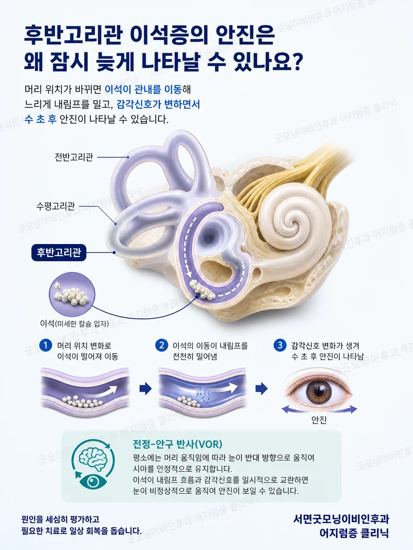 후반고리관의 위치와 이석 이동 경로를 단순화한 해부 도식