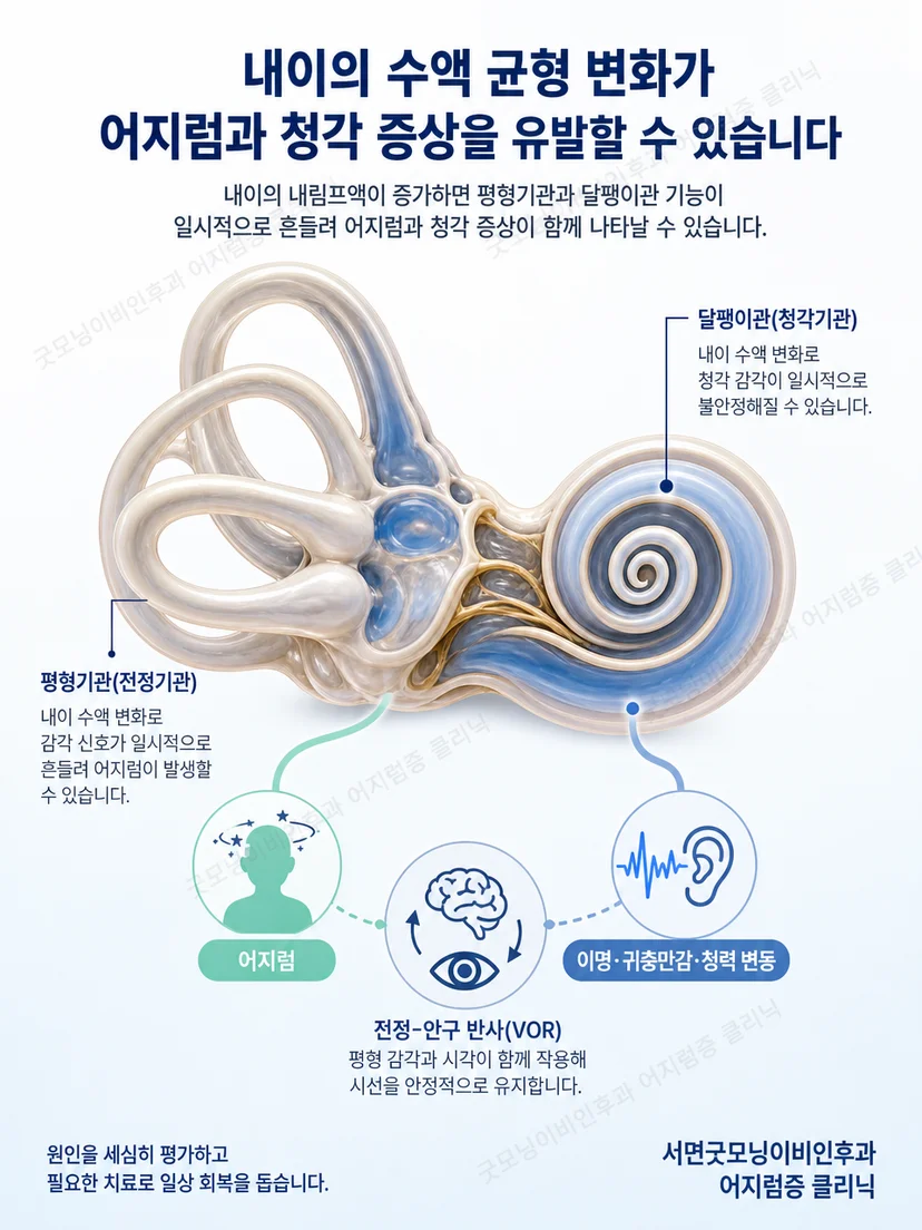메니에르병에서 내이와 청력 변동의 관계를 설명하는 이미지