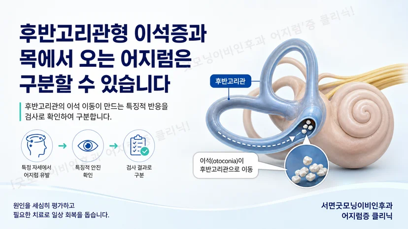 후반고리관형 이석증과 목 관련 어지럼의 구분 핵심을 설명하는 그림