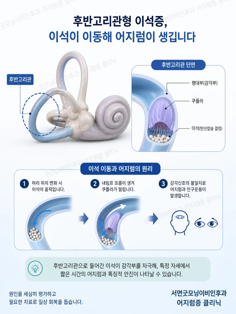 후반고리관의 위치와 이석 이동 경로를 단순화한 해부 도식