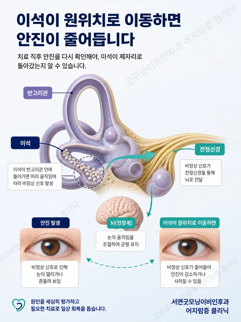 반고리관 안의 이석 이동과 자세 변화의 원리를 보여주는 교육 그림