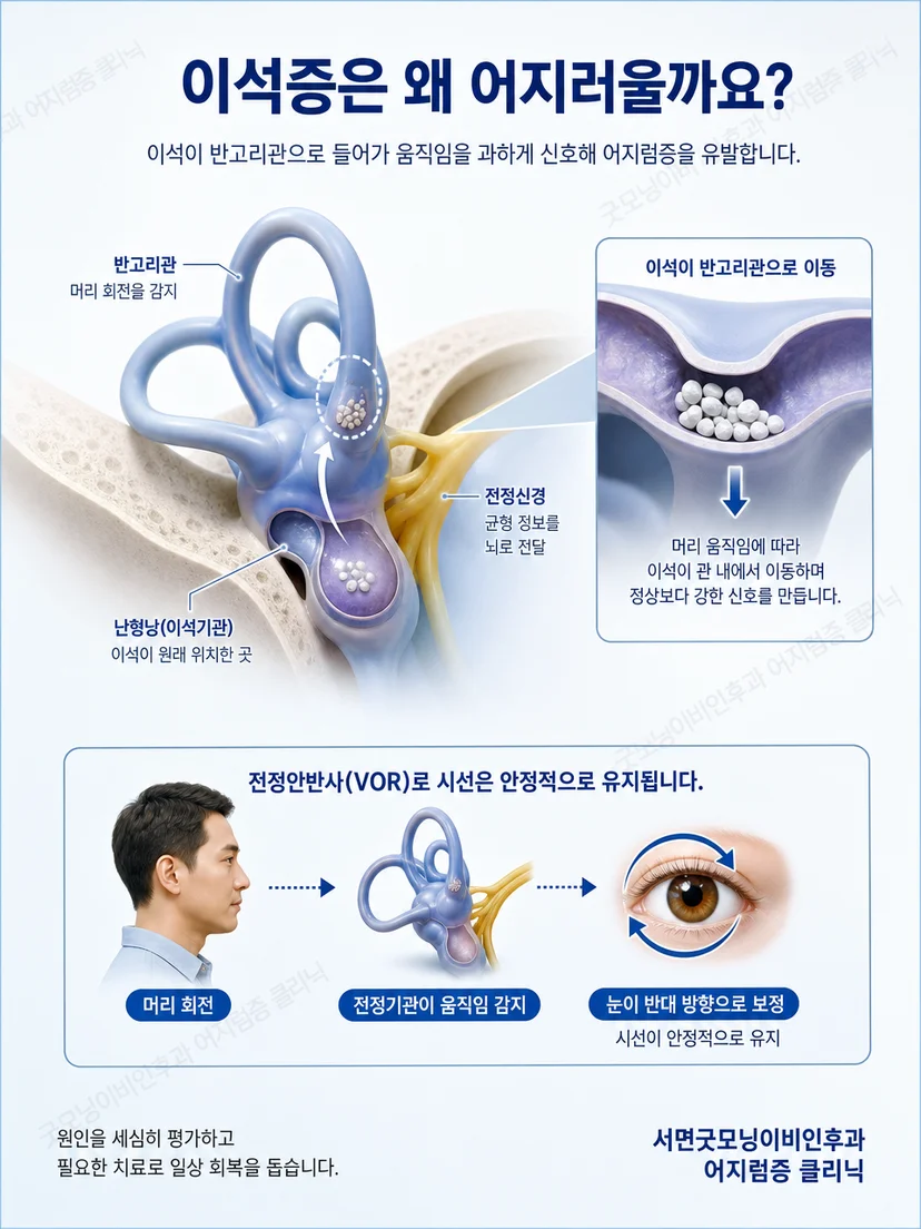 머리 위치 변화에 따라 이석증 증상이 유발되는 원리를 나타낸 그림