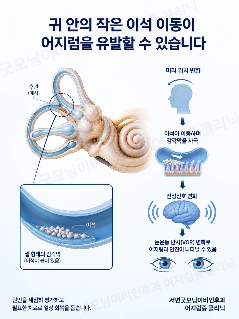 머리 자세 변화에 따라 반고리관이 자극되는 이석증 원리