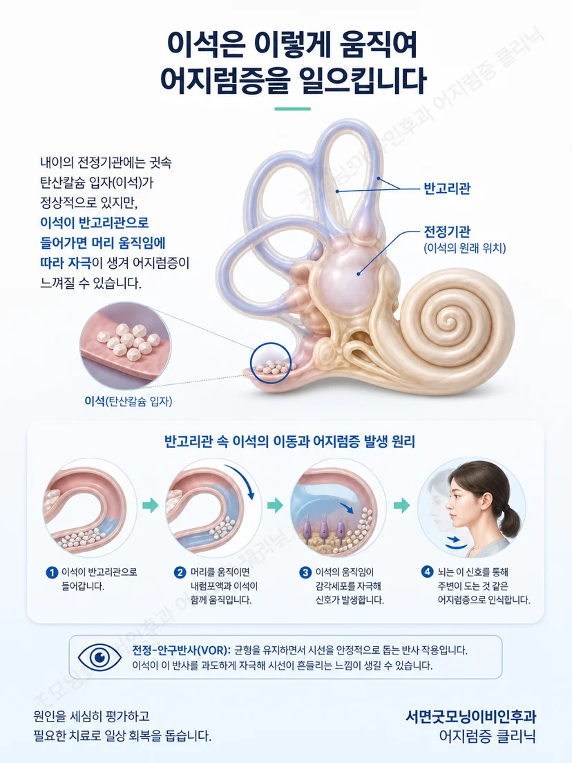 반고리관 안에서 이석이 움직이며 어지럼을 유발하는 원리