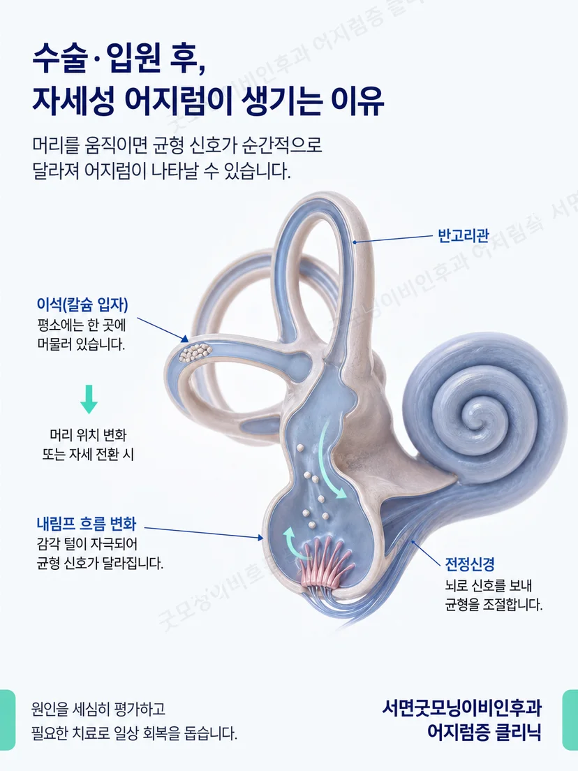 머리 위치 변화와 반고리관 자극으로 생기는 이석증 원리
