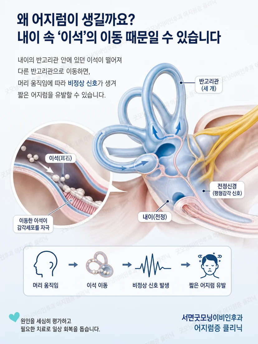 내이 반고리관과 이석 이동으로 발생하는 자세성 어지럼 원리