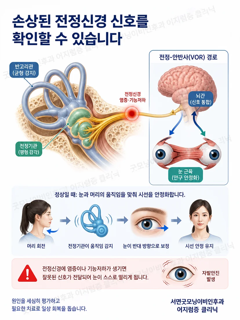 좌우 전정기관 신호 불균형과 자발안진 발생 원리를 나타낸 그림