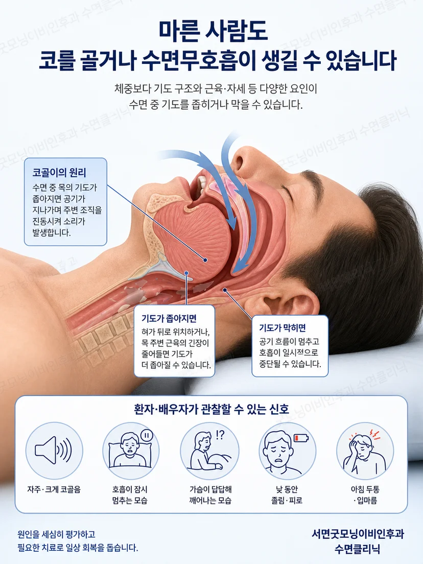 좁아진 상기도에서 연조직이 진동하는 코골이 원리 그림