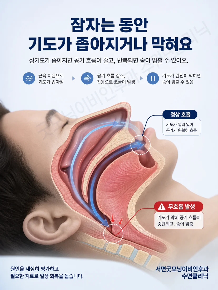 수면 중 혀와 연구개 주변 상기도가 좁아져 공기 흐름이 방해되는 원리