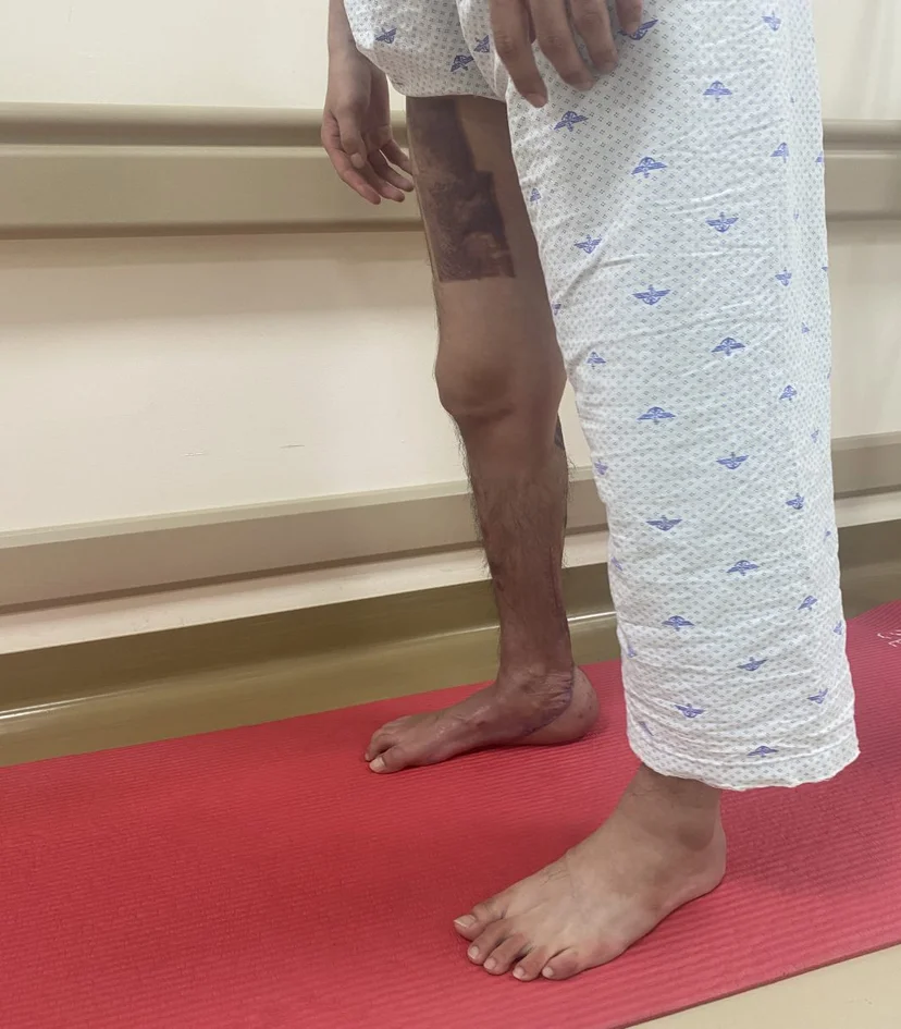 17시간 재건 수술로 살려낸 발로 다시 선 모습