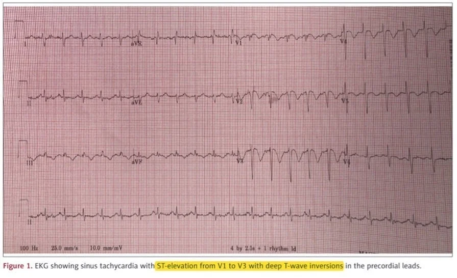 ECG of a patient