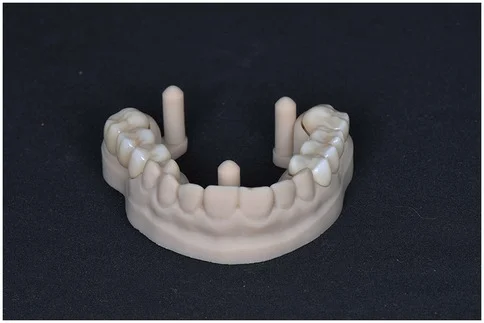 3D 프린트로 만든 위턱 작업 모형에 완성된 브릿지를 끼워 놓은 사진 (논문 도판)
